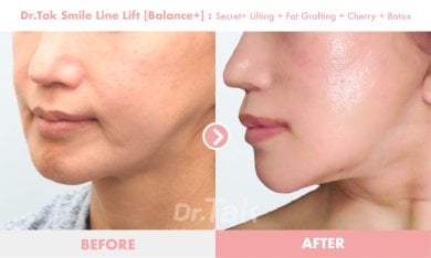 before-after photo mini-facelift