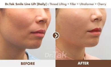 before-after photo mini-facelift
