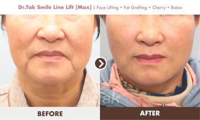 before-after photo mini-facelift