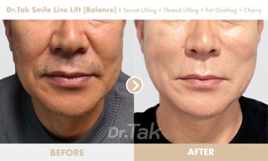before-after photo mini-facelift