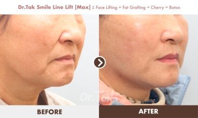 before-after photo mini-facelift