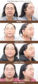 before-after photo mini-facelift