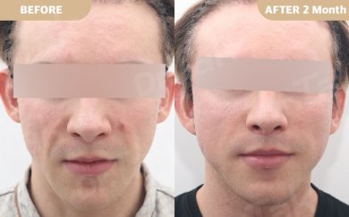 before-after photo mini-facelift
