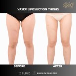 Before and after VASER liposuction thighs result at ID Clinic Bangkok, slimmer thigh contour
