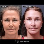 Before and after facelift results at VG Plastic Surgery, visible facial rejuvenation after 2 weeks