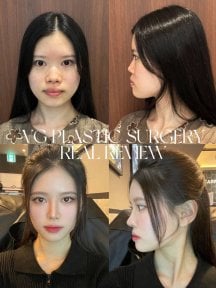 نتائج عملية تجميل الأنف قبل وبعد في VG Plastic Surgery، إعادة تشكيل الأنف وتناسق الوجه