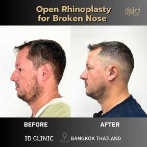 Before and after open rhinoplasty for broken nose at ID Clinic Bangkok, visible nose correction result