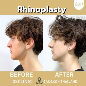 Before and after rhinoplasty results at ID Clinic Bangkok, nose reshaping for natural look