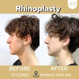 Before and after rhinoplasty results at ID Clinic Bangkok, nose reshaping for natural look