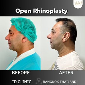 Before and after open rhinoplasty results at ID Clinic Bangkok, nose reshaping for men