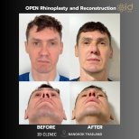 Before and after open rhinoplasty results at ID Clinic Bangkok, nose reconstruction improvement