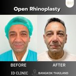 Before and after open rhinoplasty results at ID Clinic Bangkok, nose reshaping procedure