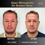 Before and after open rhinoplasty for broken nose at ID Clinic Bangkok, visible nose correction result