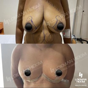 Before and after breast lift with implants at Lokman Hekim Istanbul Hospital, visible results