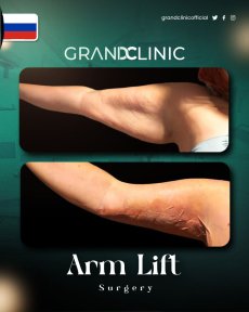 Before and after arm lift results at Grand Clinic – improved arm contour after brachioplasty