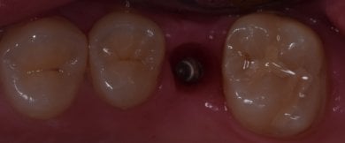 Resultado de colocación de implante dental en Shanghai Y+bo Dental Clinic, implante visible