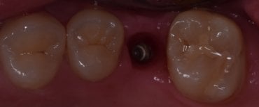 Resultado de colocación de implante dental en Shanghai Y+bo Dental Clinic, implante visible