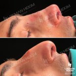 Before and after tip rhinoplasty results at Lokman Hekim Istanbul Hospital, nose reshaping