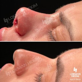 Before and after tip rhinoplasty results at Lokman Hekim Istanbul Hospital, refined nose shape