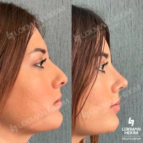 Before and after tip rhinoplasty results at Lokman Hekim Istanbul Hospital, refined nose shape