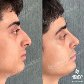 Before and after tip rhinoplasty results at Lokman Hekim Istanbul Hospital, nose reshaping