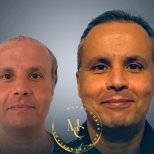 Before and after female hair transplant results at Lokman Hekim Istanbul Hospital, fuller hair