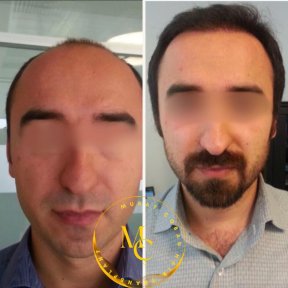 Before and after female hair transplant results at Lokman Hekim Istanbul Hospital, fuller hairline