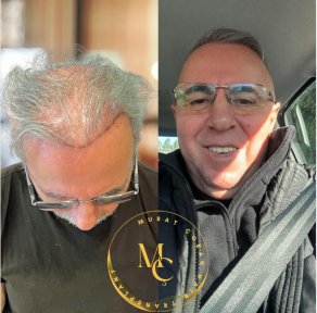 Before and after male hair transplant results at Lokman Hekim Istanbul Hospital, fuller hairline