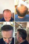 Before and after results of female hair transplant at Lokman Hekim Istanbul Hospital, fuller hair