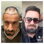 Before and after male hair transplant results at Lokman Hekim Istanbul Hospital, fuller hairline