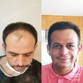 Before and after male hair transplant results at Lokman Hekim Istanbul Hospital, fuller hairline