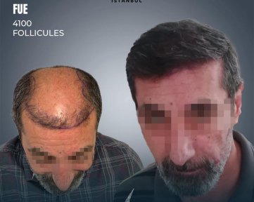 FUE hair transplant before and after results at Lokman Hekim Istanbul Hospital, 4100 follicles