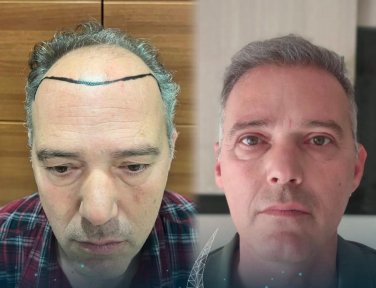 Before and after female hair transplant result at Lokman Hekim Istanbul Hospital, fuller hairline