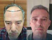 Before and after female hair transplant result at Lokman Hekim Istanbul Hospital, fuller hairline