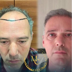 Before and after male hair transplant results at Lokman Hekim Istanbul Hospital, fuller hairline
