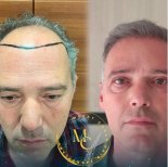 Before and after male hair transplant results at Lokman Hekim Istanbul Hospital, fuller hairline
