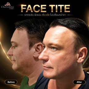 Before and after FaceTite results at Charismma Clinic – visible facial contour improvement