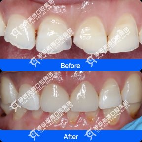 Before and after Emax veneers results at Wuhan Yiya Simei Dental Hospital, smile makeover