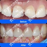 Before and after Emax veneers results at Wuhan Yiya Simei Dental Hospital, smile makeover