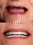 Before and after All-on-6 dental implants result at Darya Dental Turkey, full smile restoration