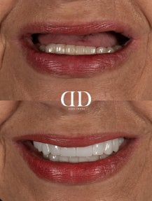 Результат до і після імплантації All-on-4 у Darya Dental Turkey, покращення посмішки