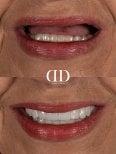 Результат до і після імплантації All-on-4 у Darya Dental Turkey, покращення посмішки