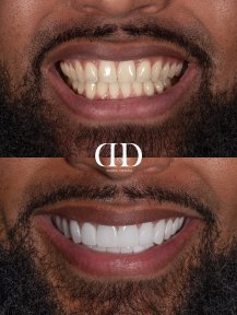 Before and after veneers at Darya Dental Turkey, smile transformation with whiter teeth result