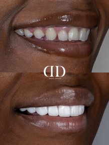 Before and after dental crown installation at Darya Dental Turkey, smile makeover results