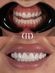 Before and after dental crown installation results at Darya Dental Turkey, smile transformation