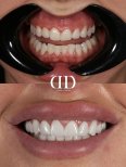 Before and after dental crown installation results at Darya Dental Turkey, smile transformation