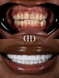 Результат до та після встановлення коронок у Darya Dental Turkey, трансформація посмішки