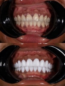 До та після встановлення зубних коронок у Darya Dental Turkey, покращений результат посмішки