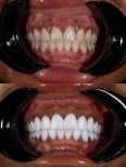 До та після встановлення зубних коронок у Darya Dental Turkey, покращений результат посмішки