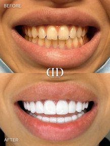 Before and after veneers at Darya Dental Turkey, smile transformation with whiter teeth result